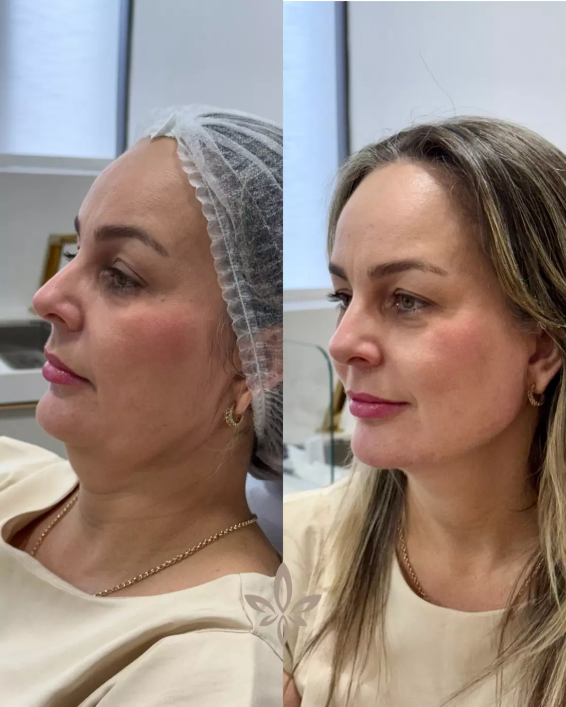 Caso Kimmy — Contorno e qualidade de pele com o Método Éclair